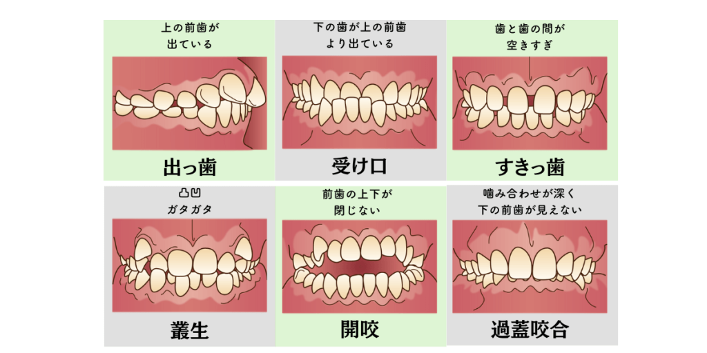出っ歯・受け口・すきっ歯・叢生・開咬・過蓋咬合など不正咬合の種類図解